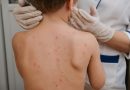 Actúa de inmediato Secretaría de Salud ante caso sospechoso de Sarampión, en Huanusco