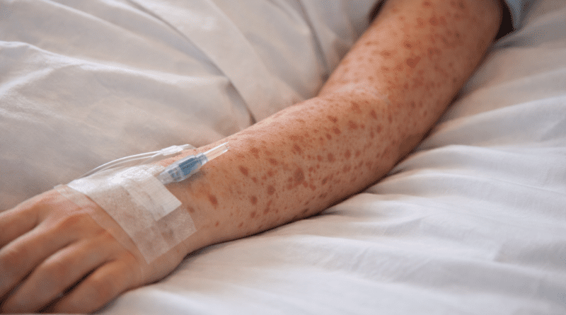 Confirma SSZ segundo caso de Sarampión en Zacatecas en lo que va de 2026